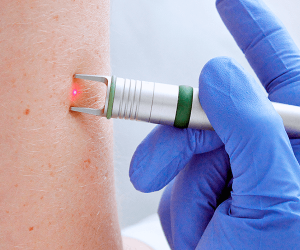 Cauterizacion laser vph