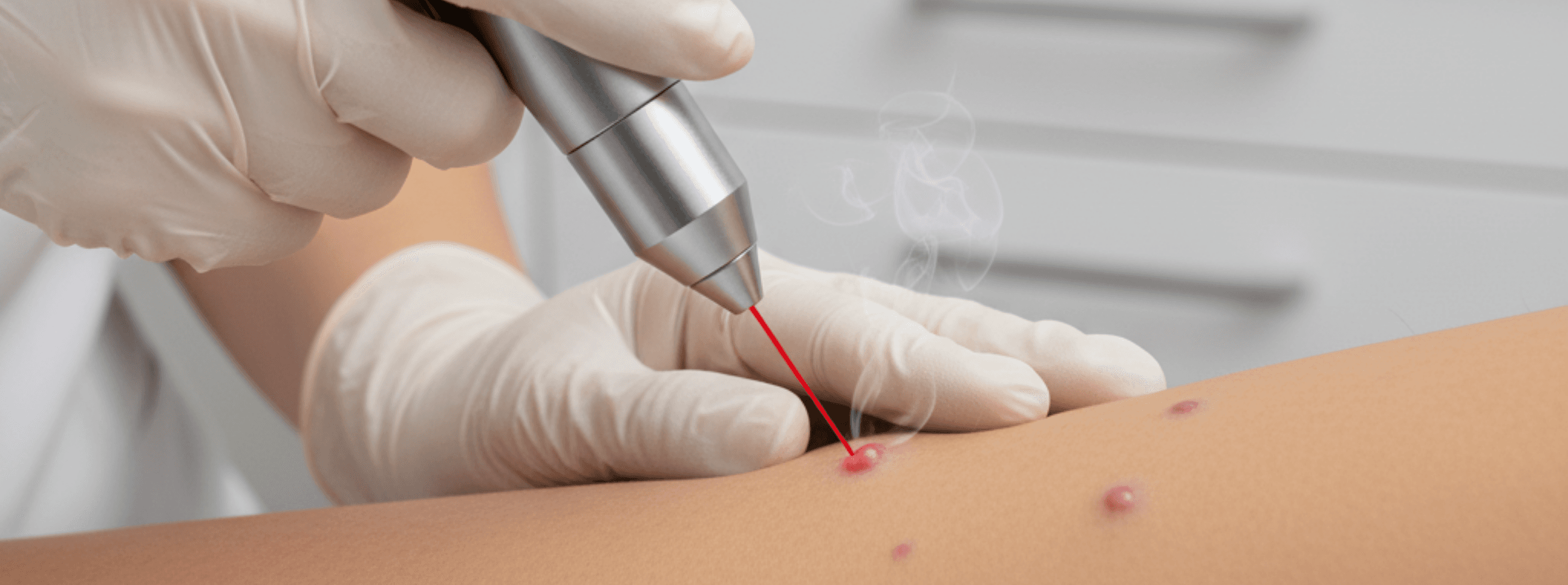 eliminacion de verrugas genitales